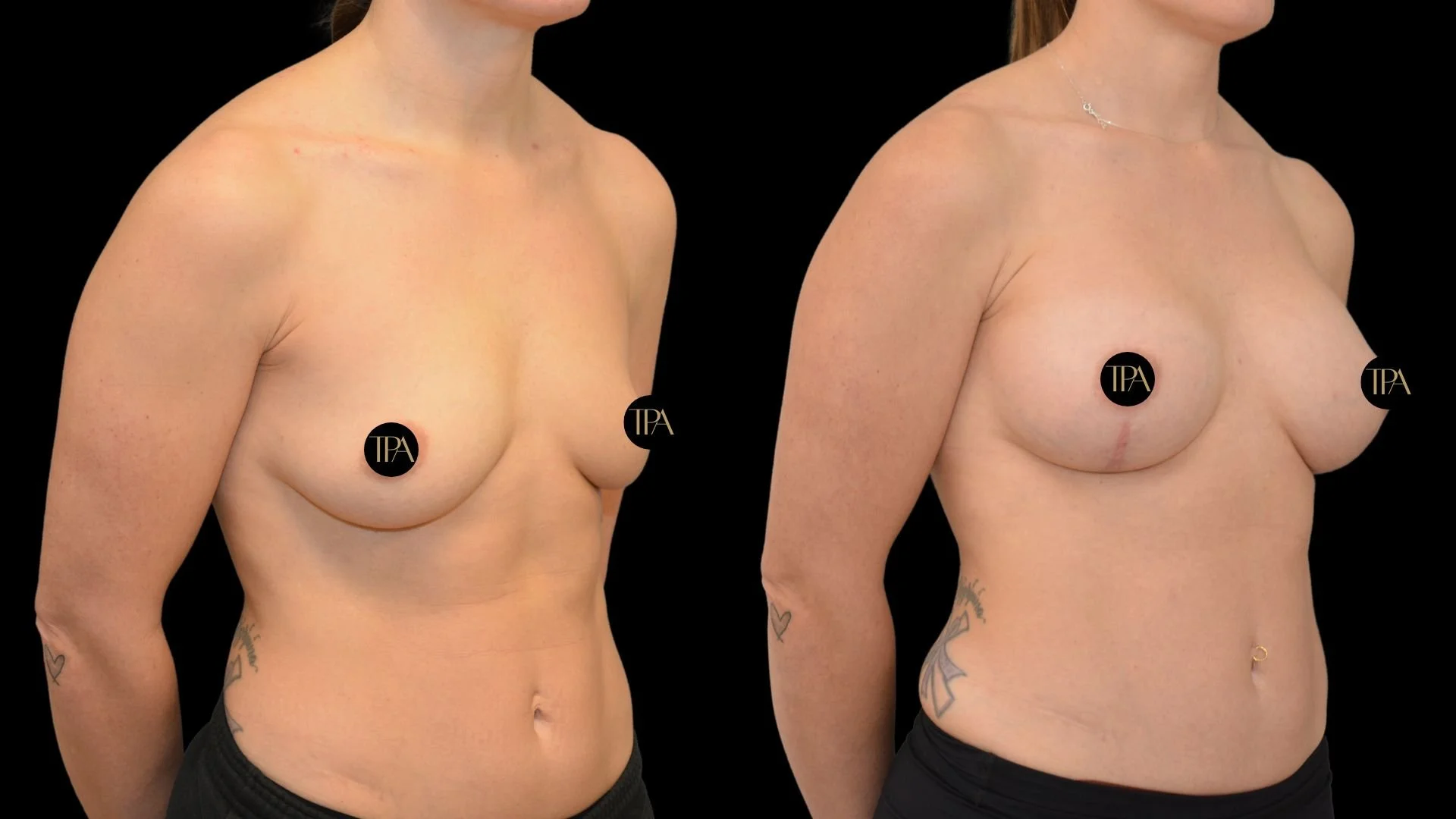 Before and after photos of a woman's chest showing the results of breast surgery with visible scars.