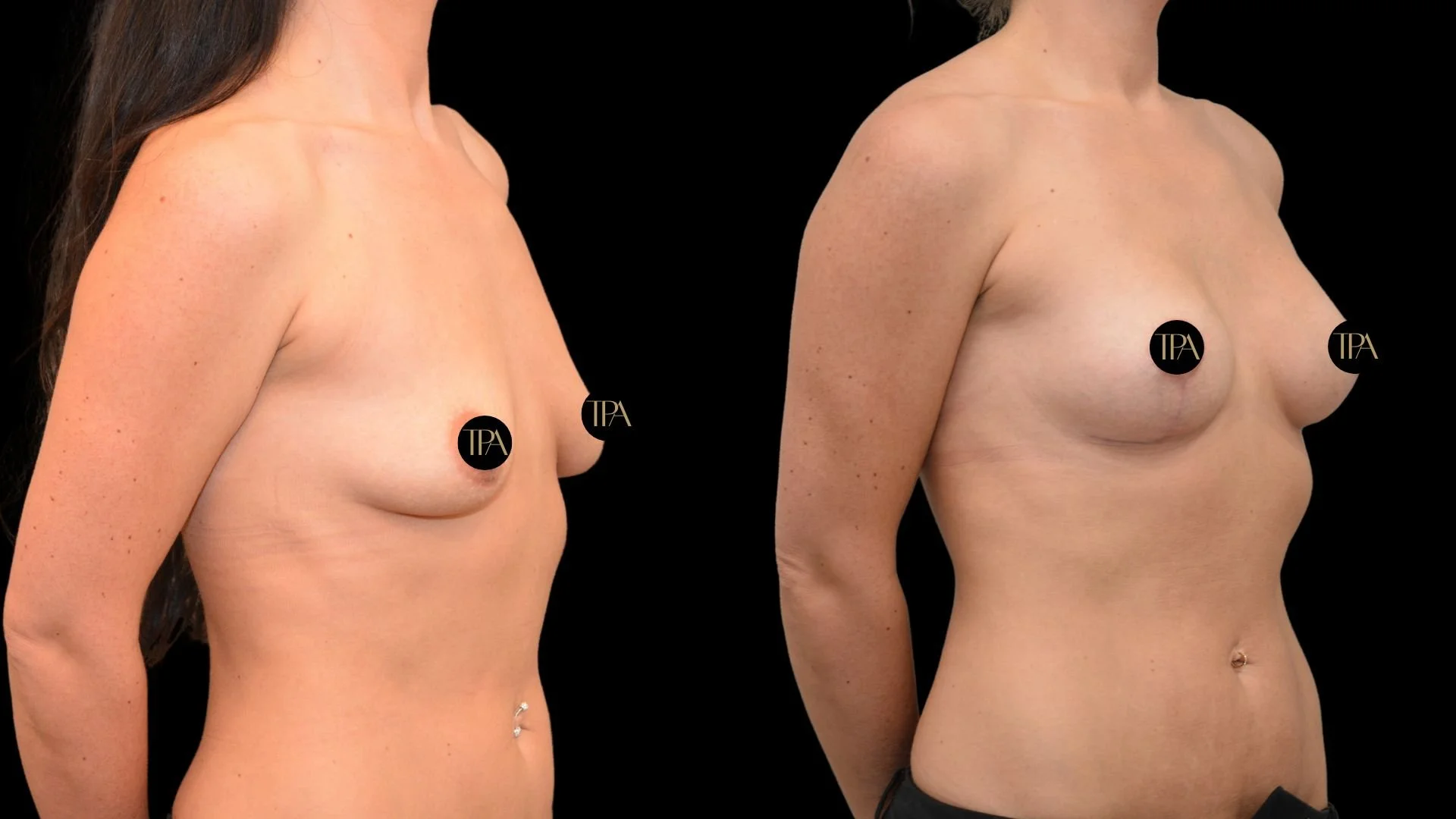 Side-by-side before and after images of a woman's torso showing breast enhancement or reconstruction, with black background and black circles with gold initials covering nipples.