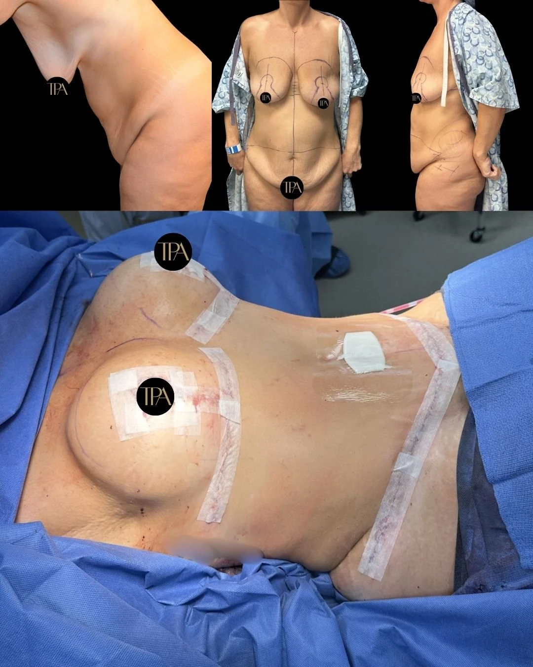 Sequence of images showing a woman undergoing breast surgery. The top images display preoperative markings on her chest, with her wearing a hospital gown. The bottom image shows her lying on the operating table with surgical drapes and some medical e