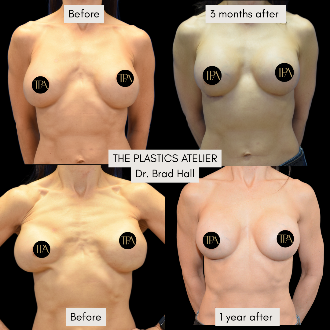 Series of four images showing before and after photos of a woman's breast augmentation and lift. Top left: woman before procedure, top right: three months after, bottom left: woman before second procedure, bottom right: one year after. Branding overl