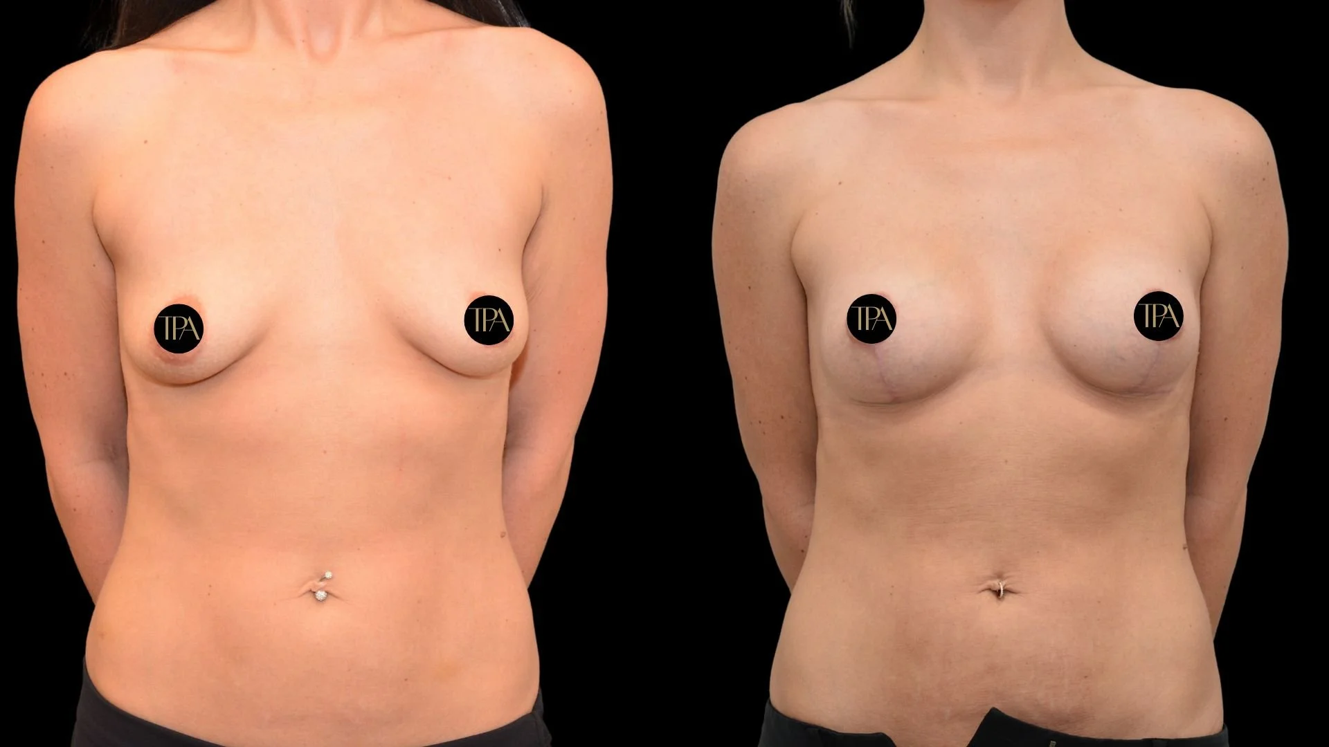 Comparison of a woman's bare torso before and after breast augmentation surgery, showing changes in breast size and shape with black background.