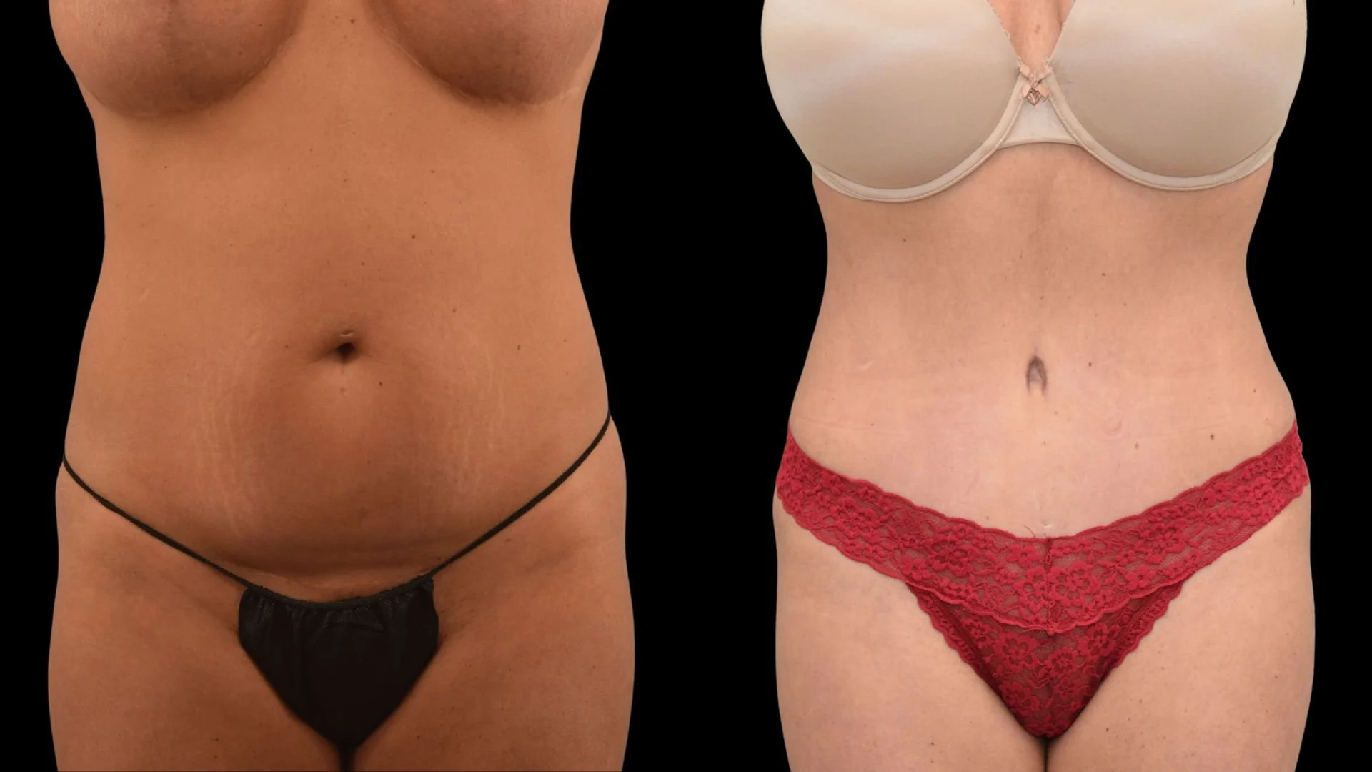 Side-by-side comparison of a woman’s torso showing before and after body transformation, with visible reduction in abdominal fat and improved skin tone, wearing minimal clothing.