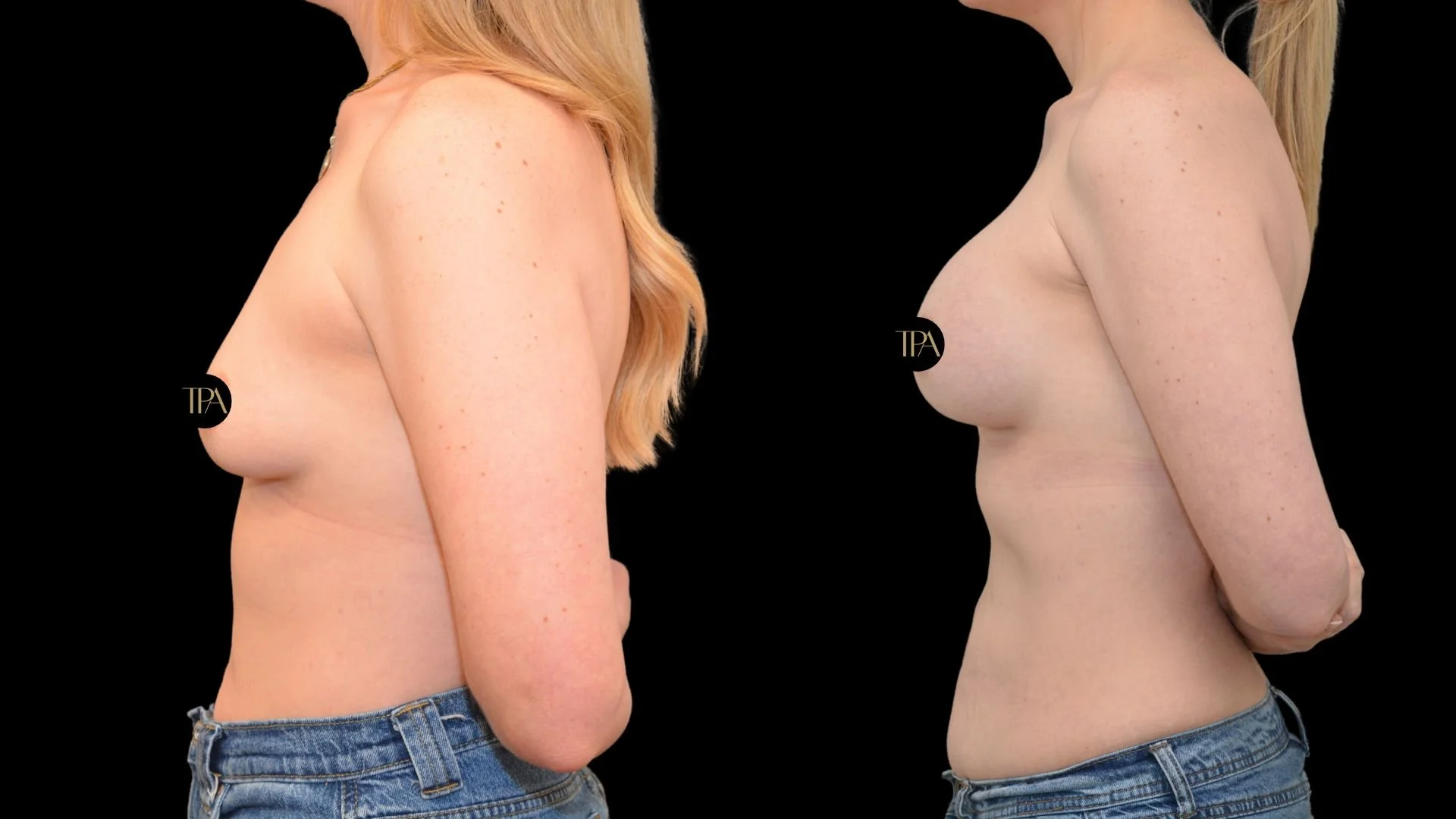 Side-by-side comparison of a woman's bare chest before and after breast enhancement, with black background.