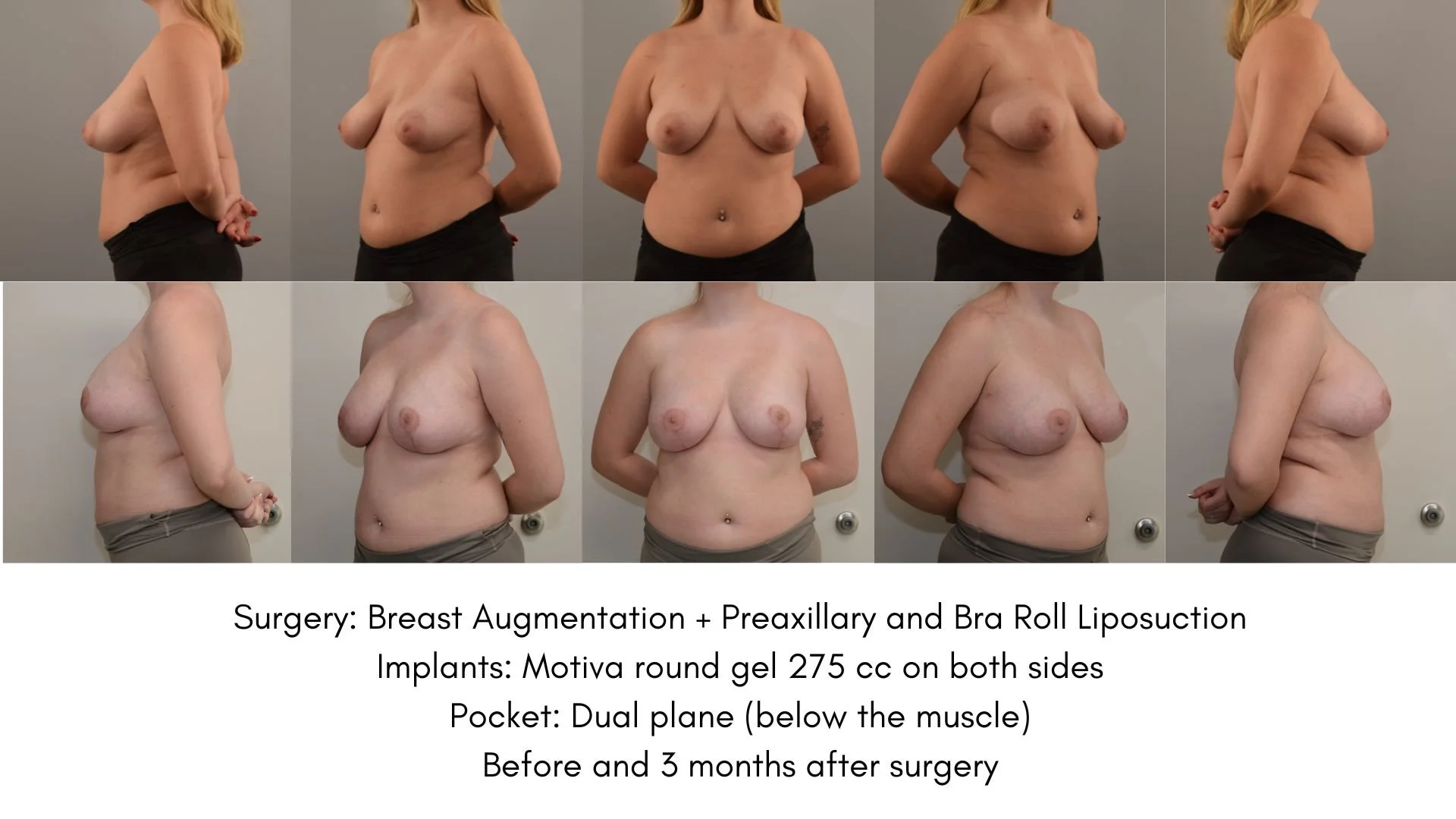 A collage of ten photos showing a woman's before and after breast surgery results, with medical procedures listed as breast augmentation, preaxillary and bra roll liposuction, and implants of Motiva round gel 275 cc. The photos include front and side