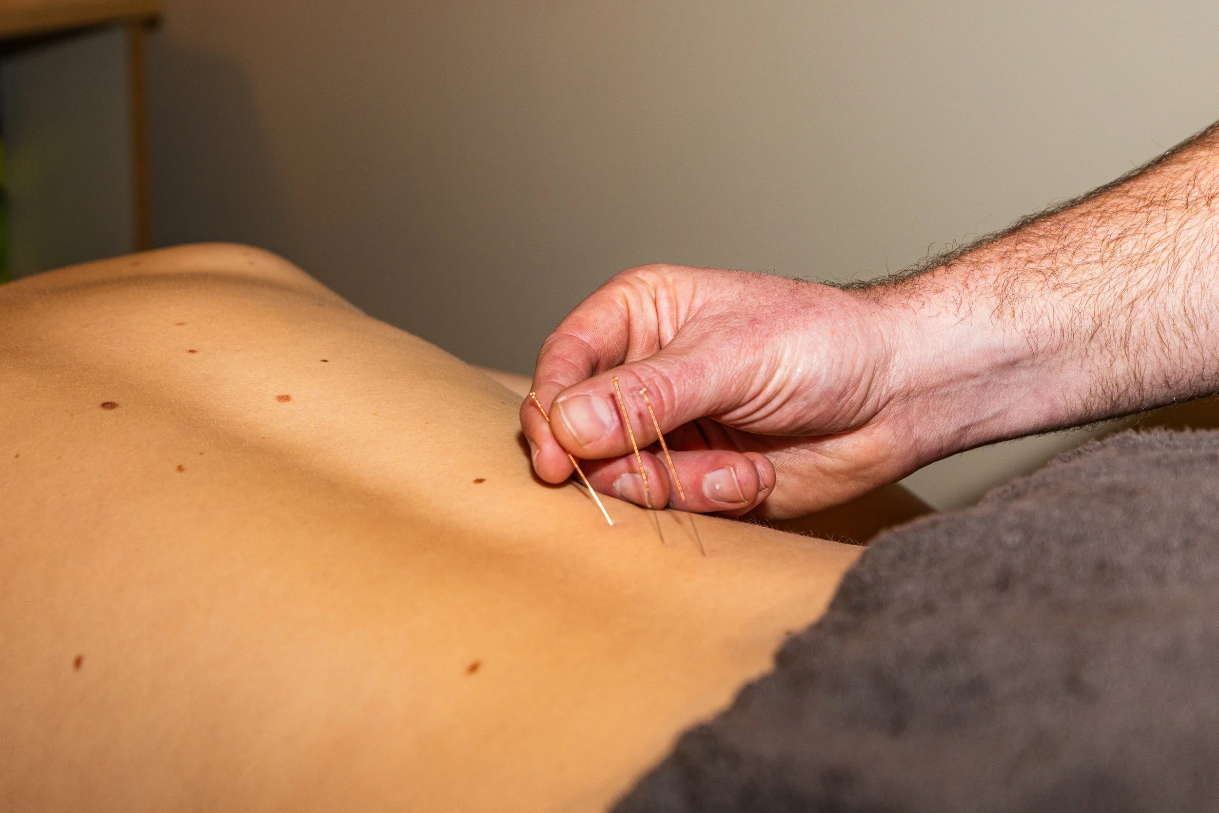 A person with a back injury receiving dry needling from a Physio at Peak Sports Physio Hakuba