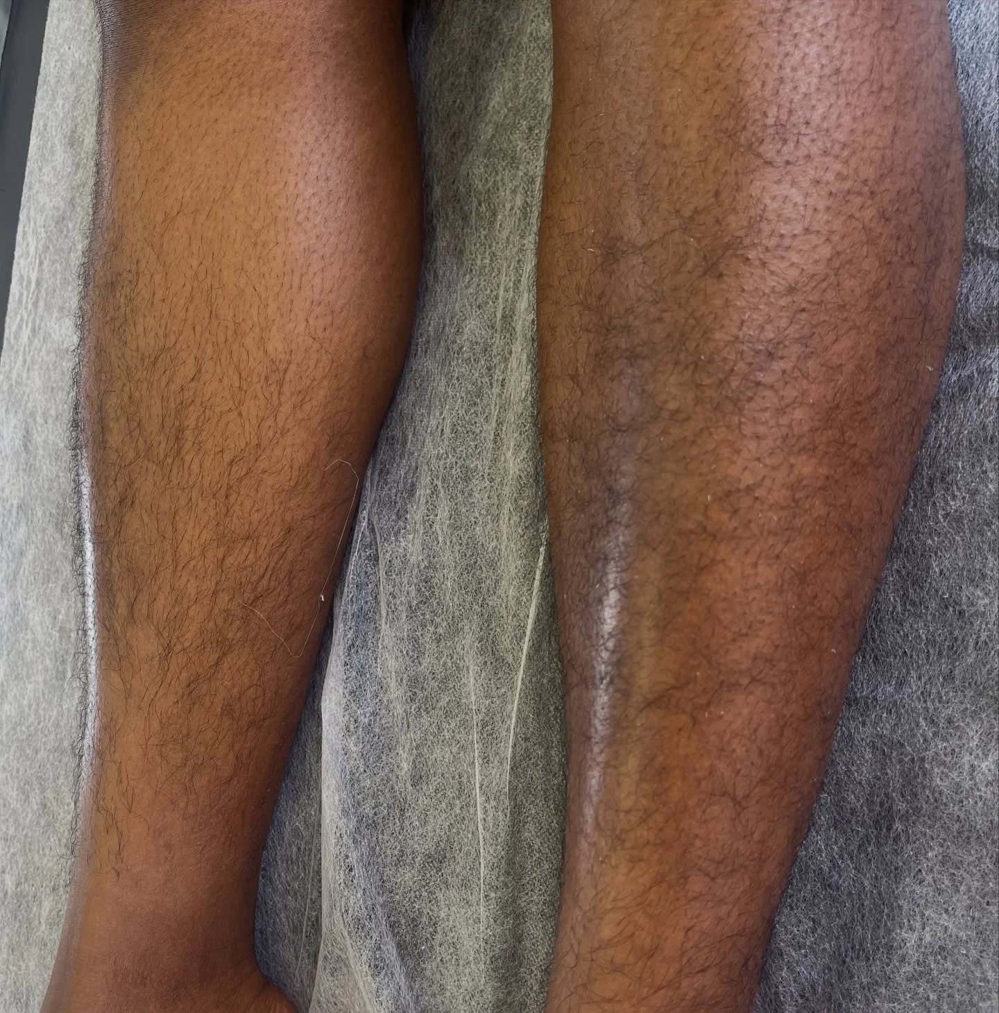 𝐒𝐰𝐢𝐩𝐞 𝐭𝐨 𝐬𝐞𝐞 𝐭𝐡𝐞 𝐚𝐟𝐭𝐞𝐫😩✨
𝐋𝐞𝐠𝐬 𝐟𝐨𝐫 𝐝𝐚𝐲𝐬 💅🏽 

𝐅𝐨𝐥𝐥𝐨𝐰 @cerabloomwax 💌💌
-
-
-
#BhamWaxing #Waxing #WomensWax #Birmingham