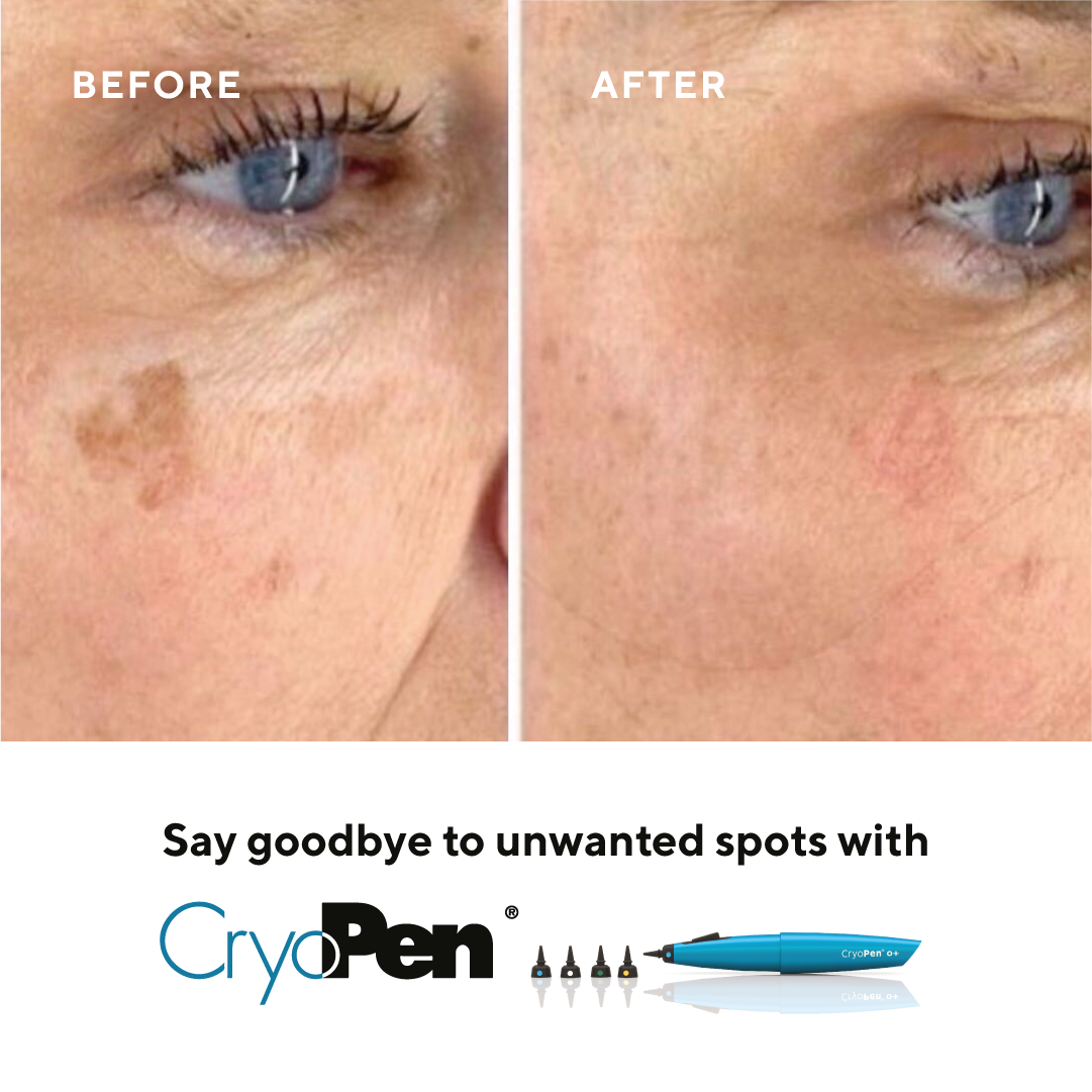 Side-by-side comparison of a woman's face showing the removal of dark spots. The 'Before' image displays uneven skin tone with visible dark patches around the eye, while the 'After' image shows clear, even-toned skin. Text promotes CryoPen for removing unwanted spots.