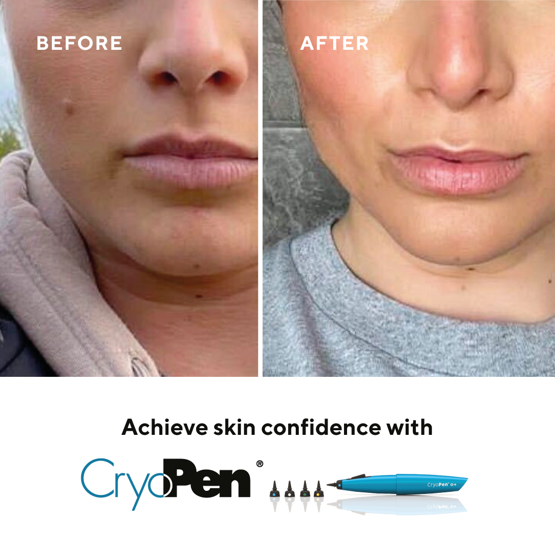 Mole-removal-treatment-aesculus-clinic