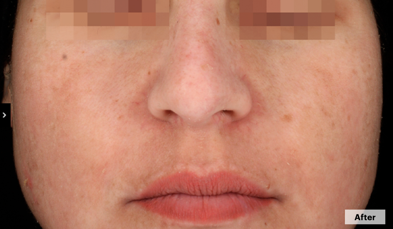 After cosmelan treatment