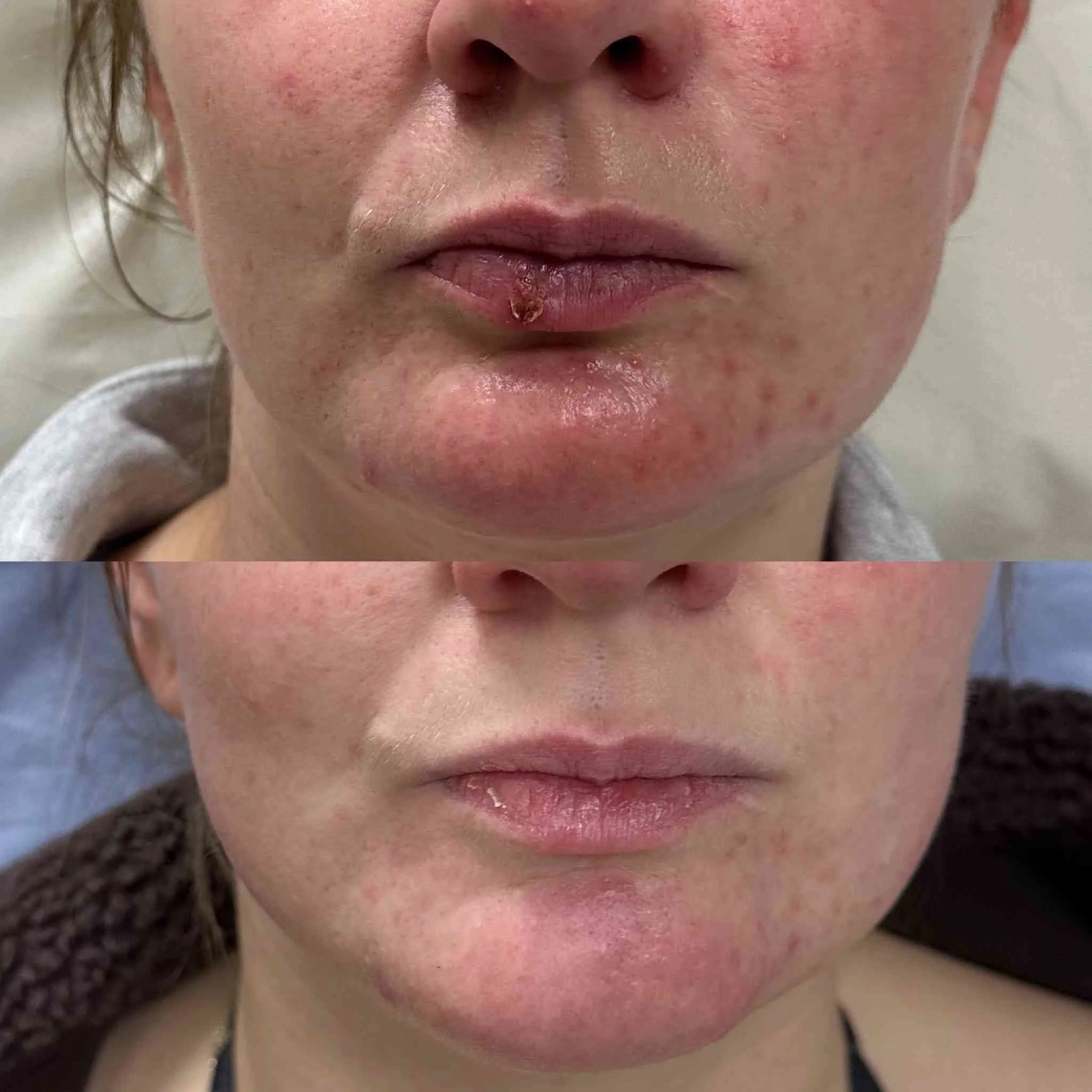 redness exosomes