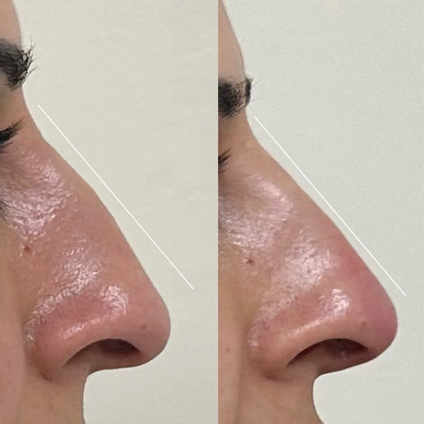 ✨ One of the most transformative treatments we offer is non-surgical rhinoplasty &mdash; because it can truly be life-changing.

Many of our patients tell us they can finally look in the mirror without their nose being the first thing they see.

At A