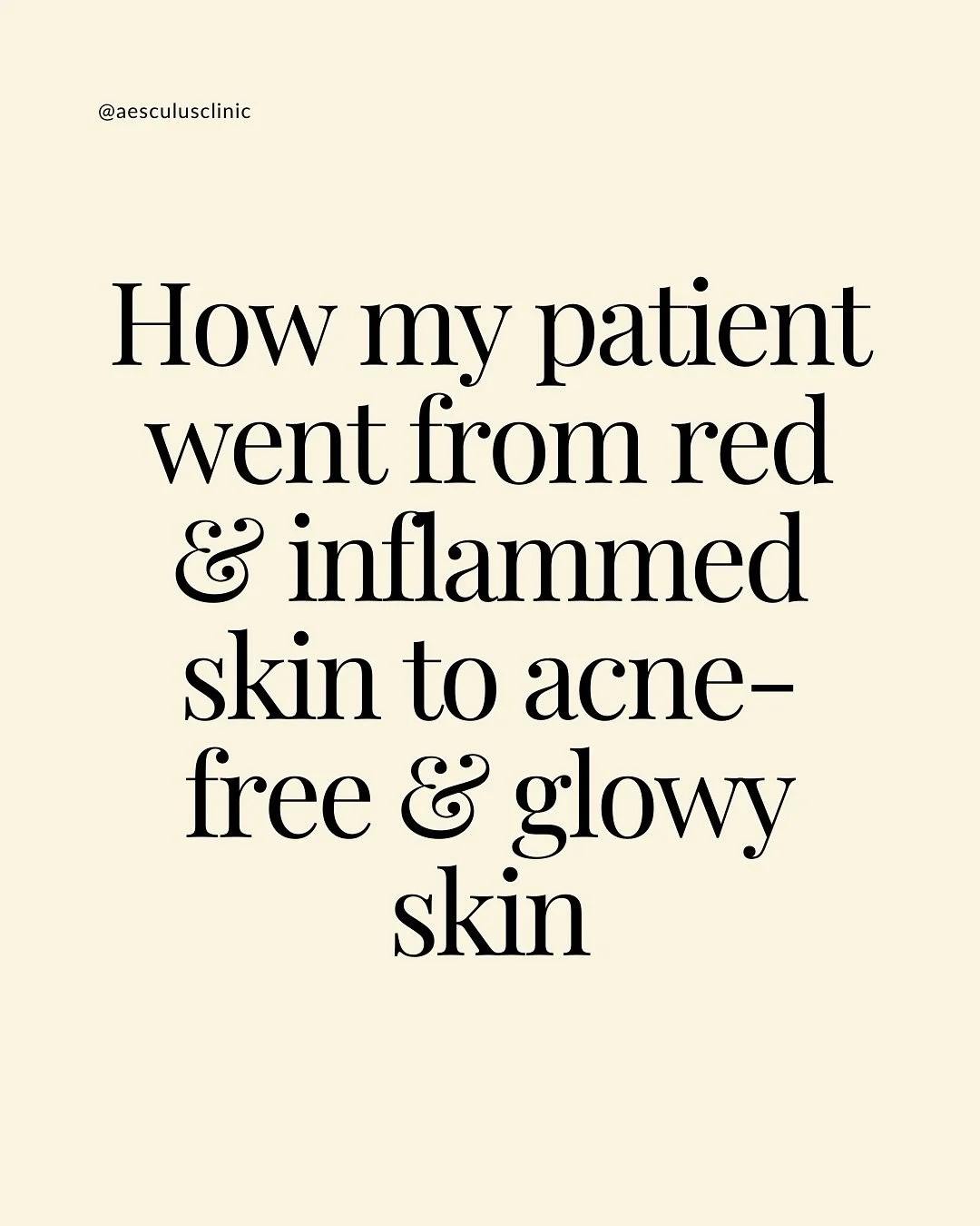 Her result wasn&rsquo;t a miracle, it was consistency, trust and patience. 
Our bespoke acne treatment involves different modalities to help you achieve the best outcome. 

Patients see improvement in their skin from 6-12 weeks.

If you are strugglin