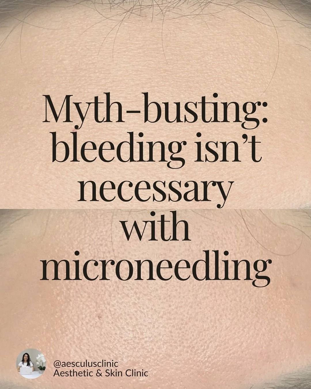 With medical microneedling, the goal is controlled redness (a sunburn-like flush for 12&ndash;24 hours), not trauma. 

I tailor needle depth and passes to your skin so we stimulate collagen and refine pores/texture while protecting your barrier. 

Ex