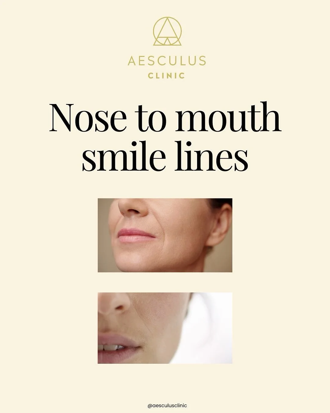 Which one do you a nasolabial fold or crease? 

Aesculus Clinic | Skin Clinic New Malden | Skin Clinic Knightsbridge | Dermal filler New Malden
