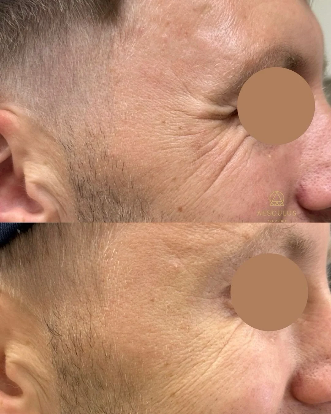 4 weeks until Christmas!! Don&rsquo;t leave your appointment till last minute 😳

WhatsApp | DM to book in. 

Aesculus Clinic | Aesthetics New Malden | Aesthetics Knightsbridge | dermal fillers New Malden | Exosomes New Malden | Exosomes Knightsbridg