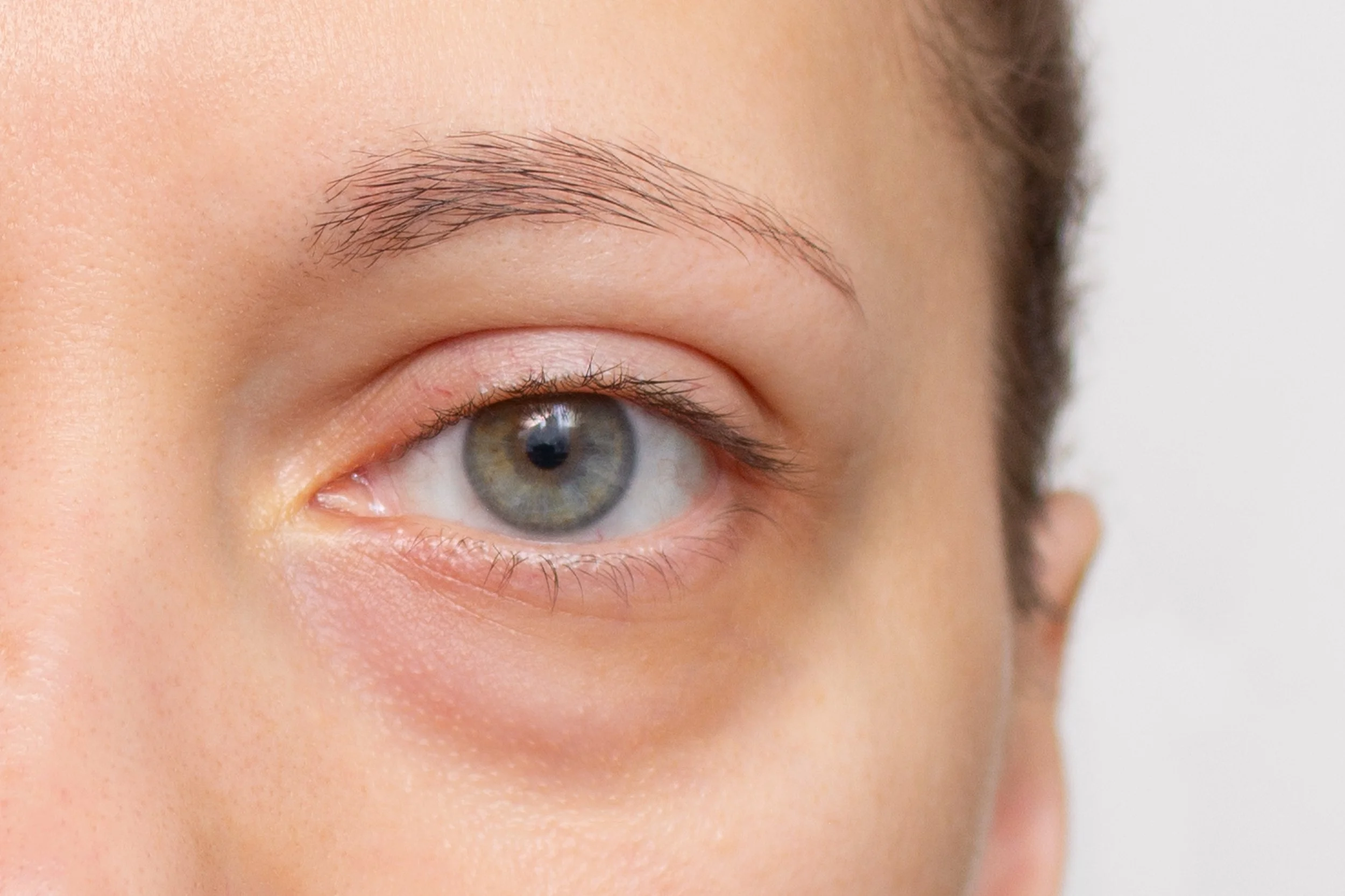 The Most Common Treatments for Under-Eye Concerns: Benefits And Limitations