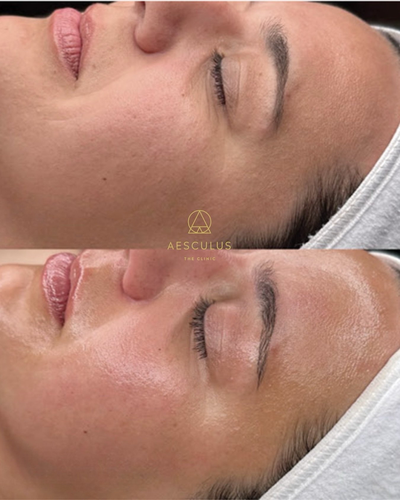 If you&rsquo;re struggling with dryness in this weather, Hydrafacial can hydrate your skin without damaging your skin barrier. 

Book your appointment online. 

Hydrafacial New Malden | Aesthetic Clinic New Malden | Non-surgical