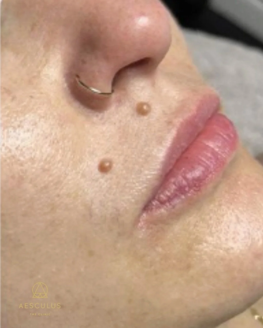 No matter the occasion, Hydrafacial can improve your skin and get you glowing!

Book your appointment online ✨

Hydrafacial New Malden | Hydrafacial Kingston | Hydrafacial Wimbeldon | Hydrafacial Raynes Park