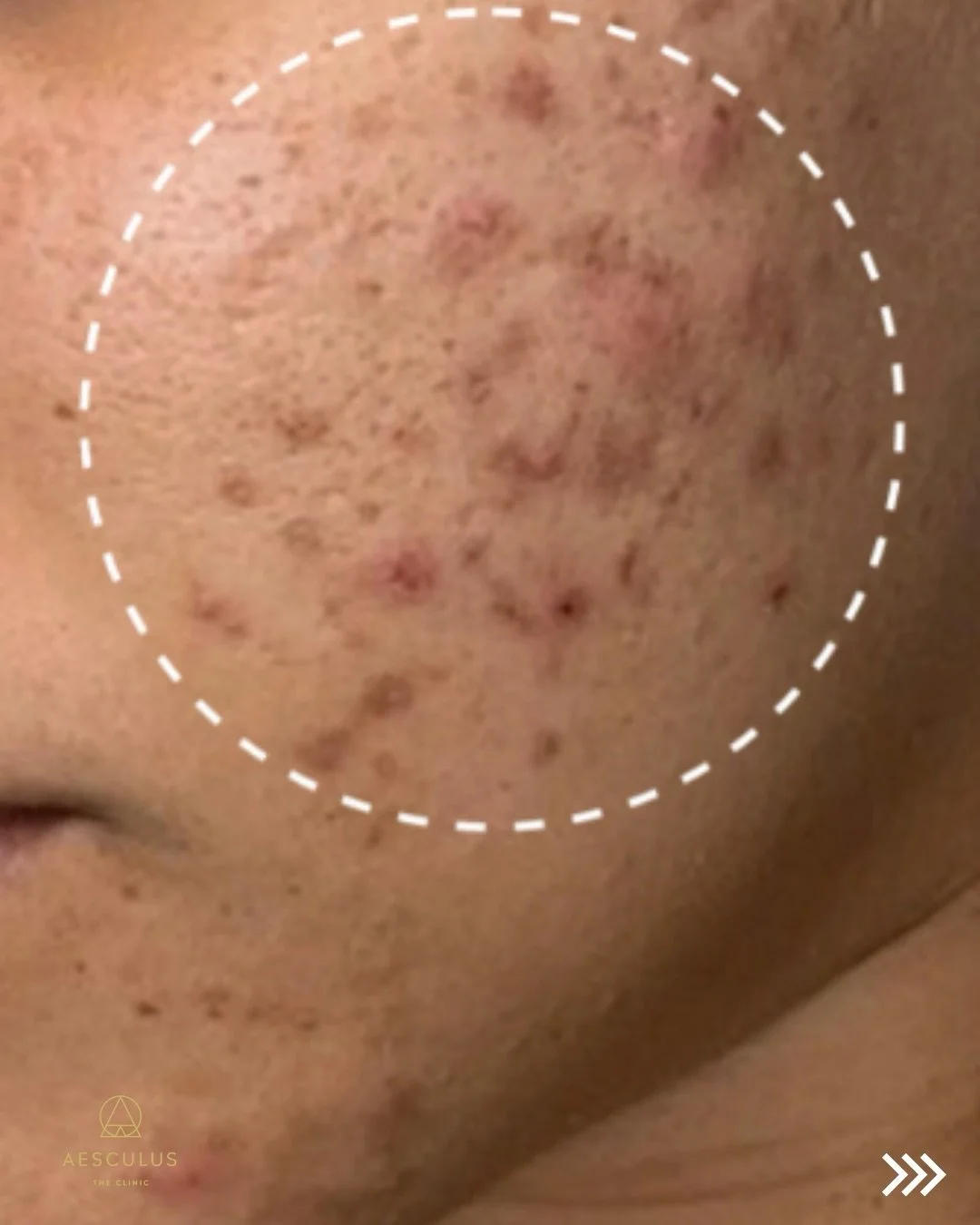 Did you know improving your skin barrier is one of the most important steps in your aesthetics journey? 

Book your appointment online. 

Hydrafacial New Malden | Hydrafacial Kingston | Hydrafacial Wimbeldon | Hydrafacial Raynes Park