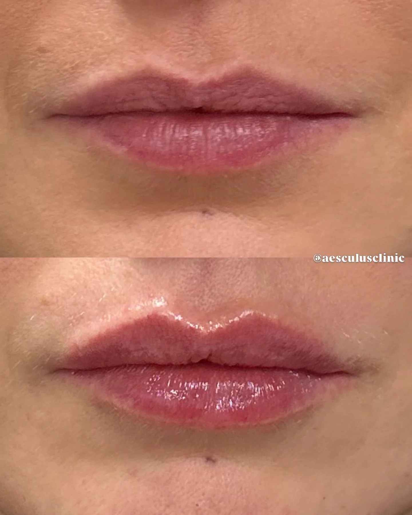 Ending the day with these hydrated and natural looking lips, no ledge, no migration just plump and rejuvenated. 

At Aesculus Clinic, we pride ourselves in providing natural looking Tweakements that will not change how you look or who you are, just m