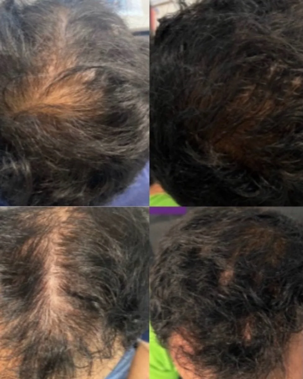 The power of Exosomes for hair loss! 

We only use a scientifically backed and evidence based product with over 50 publications. 

Book your hair consultation online. 

Hair loss new Malden | male pattern baldness | female pattern baldness | Exosomes