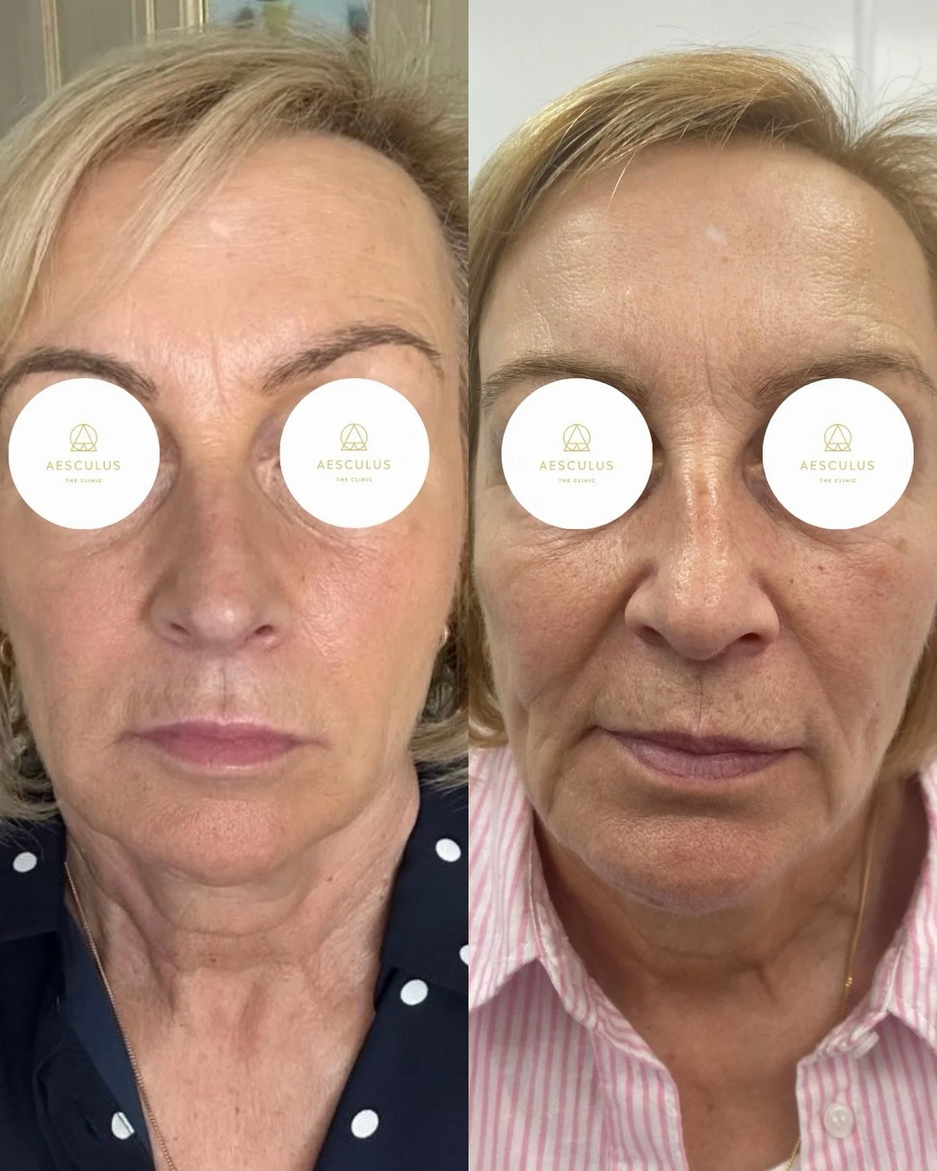 This is one of my favourite full face rejuvenation results because of how natural it looks. Nothing about it feels overdone or obvious just fresher, softer, and more rested. 

The goal was not to change features, but to gently restore what time has r