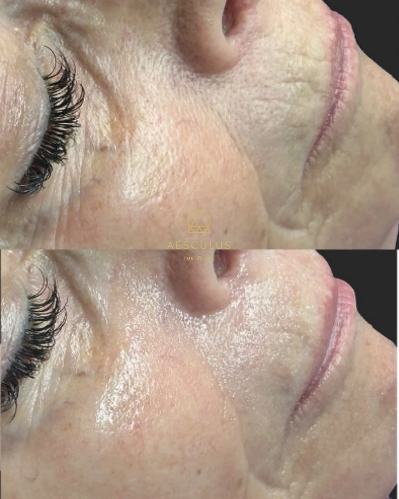 For those who don&rsquo;t want to use any injectables but want to improve their skin quality, Hydrafacial can help hydrate the skin and support the skin barrier giving you a glowing healthy complexion without any 💉 

Book your appointment online! 

