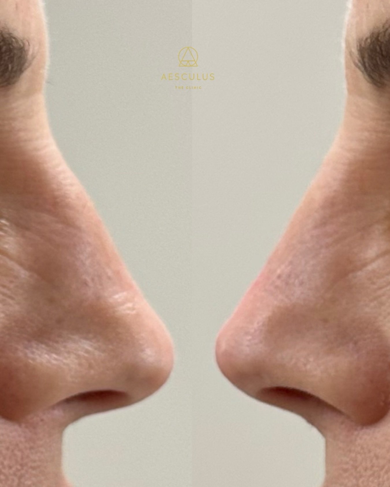 Non-surgical rhinoplasty can create a beautiful improvement with very small, carefully placed adjustments.

But it&rsquo;s also one of the treatments that demands the greatest level of respect.

The nose has a complex vascular anatomy, and dermal fil