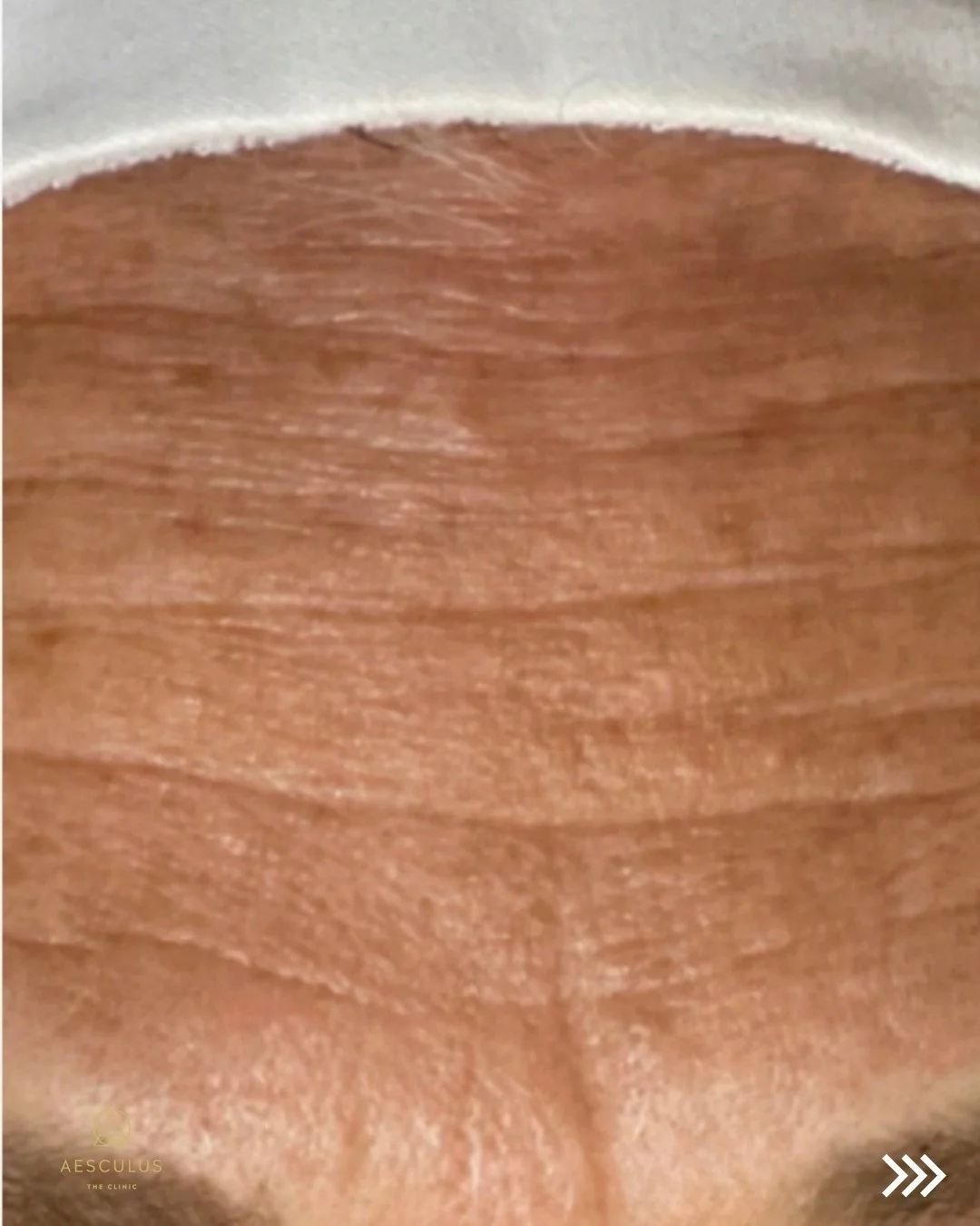 10 years younger! Hydrafacial is a great non-invasive treatment that can improve your skin and support your barrier. Regular treatments can deliver fantastic results. 

Book your treatment online. 

Hydrafacial New Malden | Hydrafacial Kingston | Hyd