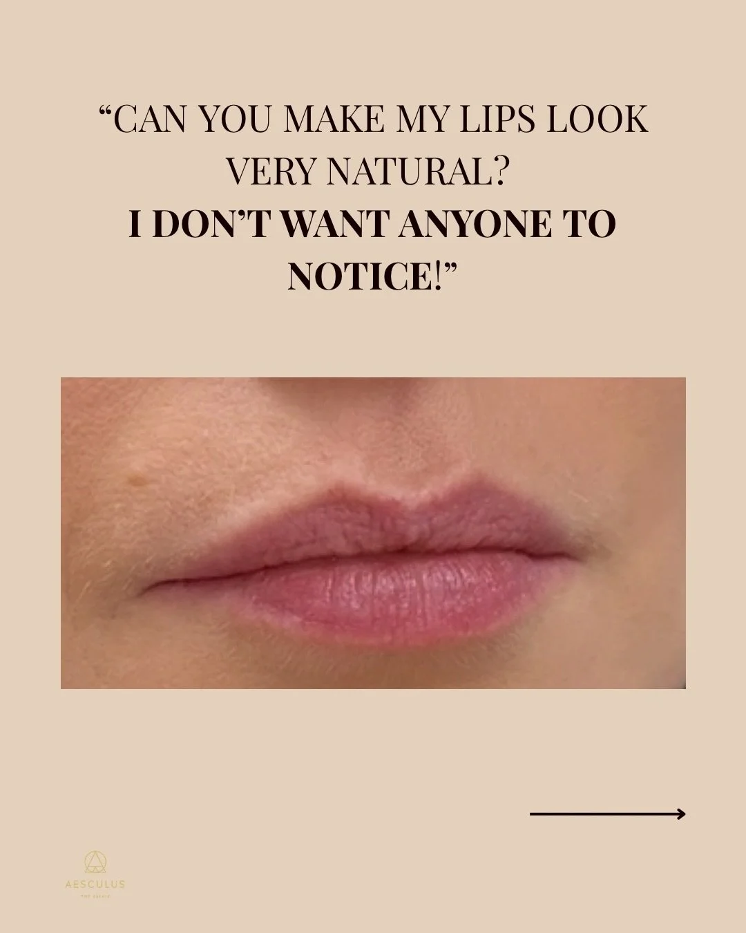 Not every lip filler looks puffy, very big and fake. In fact, it often looks like balance, hydration, and shape that belongs to your face. 

This result is a good example of what treatment should look like: subtle definition, soft volume, and lips th