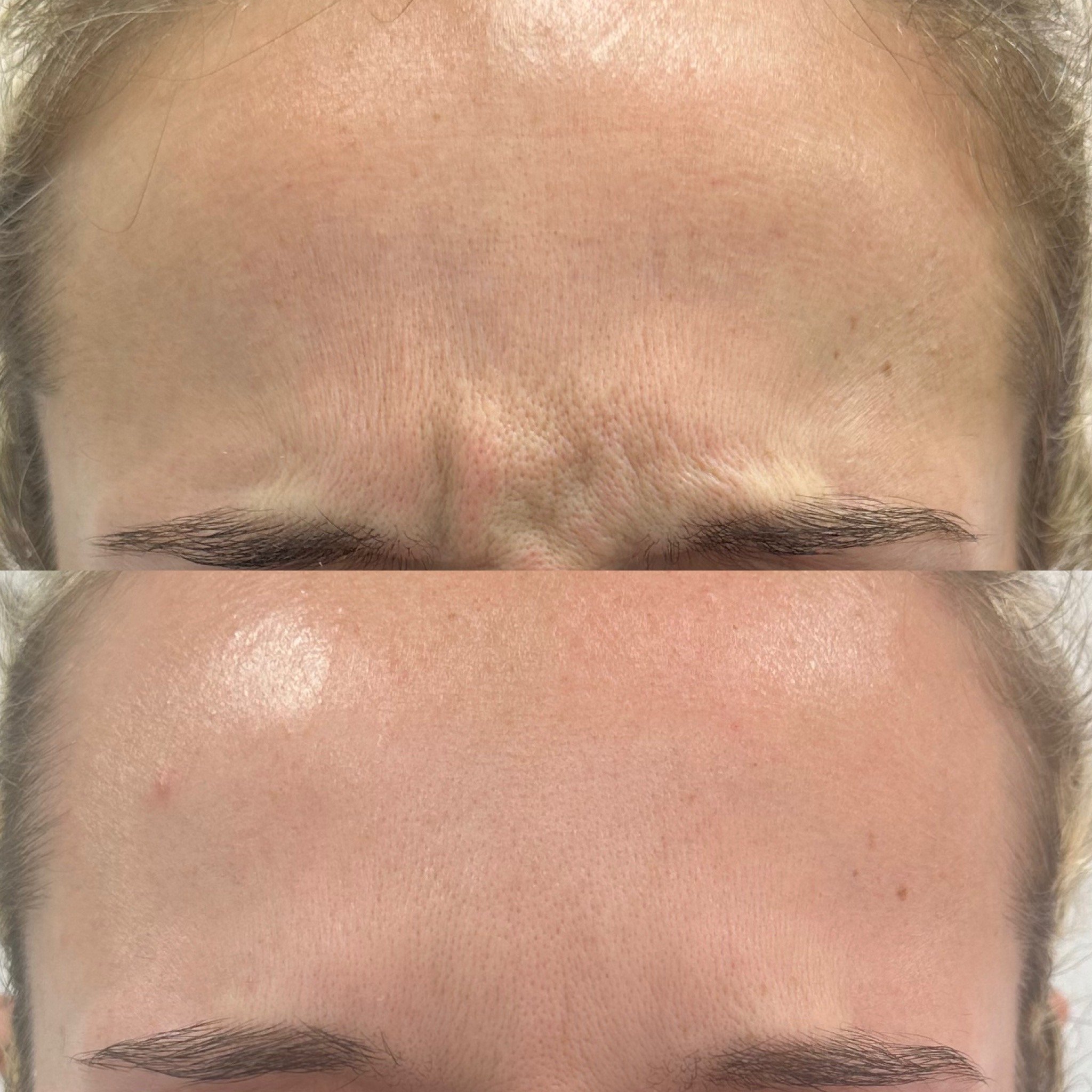 Anti-Wrinkle Treatments: Common Questions, Expert Answers