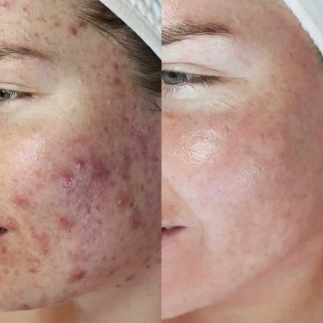 The power of phototherapy! Available in clinic now. 

Comment the word 'ACNE' and I will tell you how this was achieved!

Acne Scars Treatment New Malden | Skin Clinic New Malden | Hydrafacial New Malden | LED Therapy New Malden | Skin Clinic New Mal