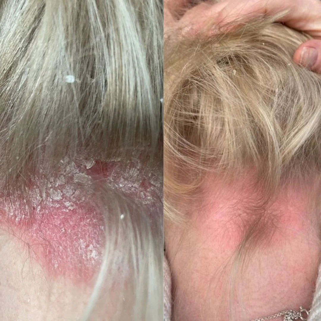 Scalp dryness and inflammation are very common symptoms I see in clinic. Treatments vary depending on the cause. Having a thorough consultation is key to identify the root cause and start the right treatment. 

Comment the word 'SCALP' if you are str