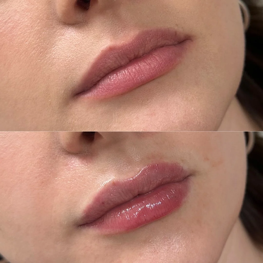She already had beautiful lips but needed a small volume to balance everything. Our lip enhancement treatment doesn't change your features or who you are. Our priority is achieving beautiful and natural results!

Aesculus Clinic | Lip Filler New Mald
