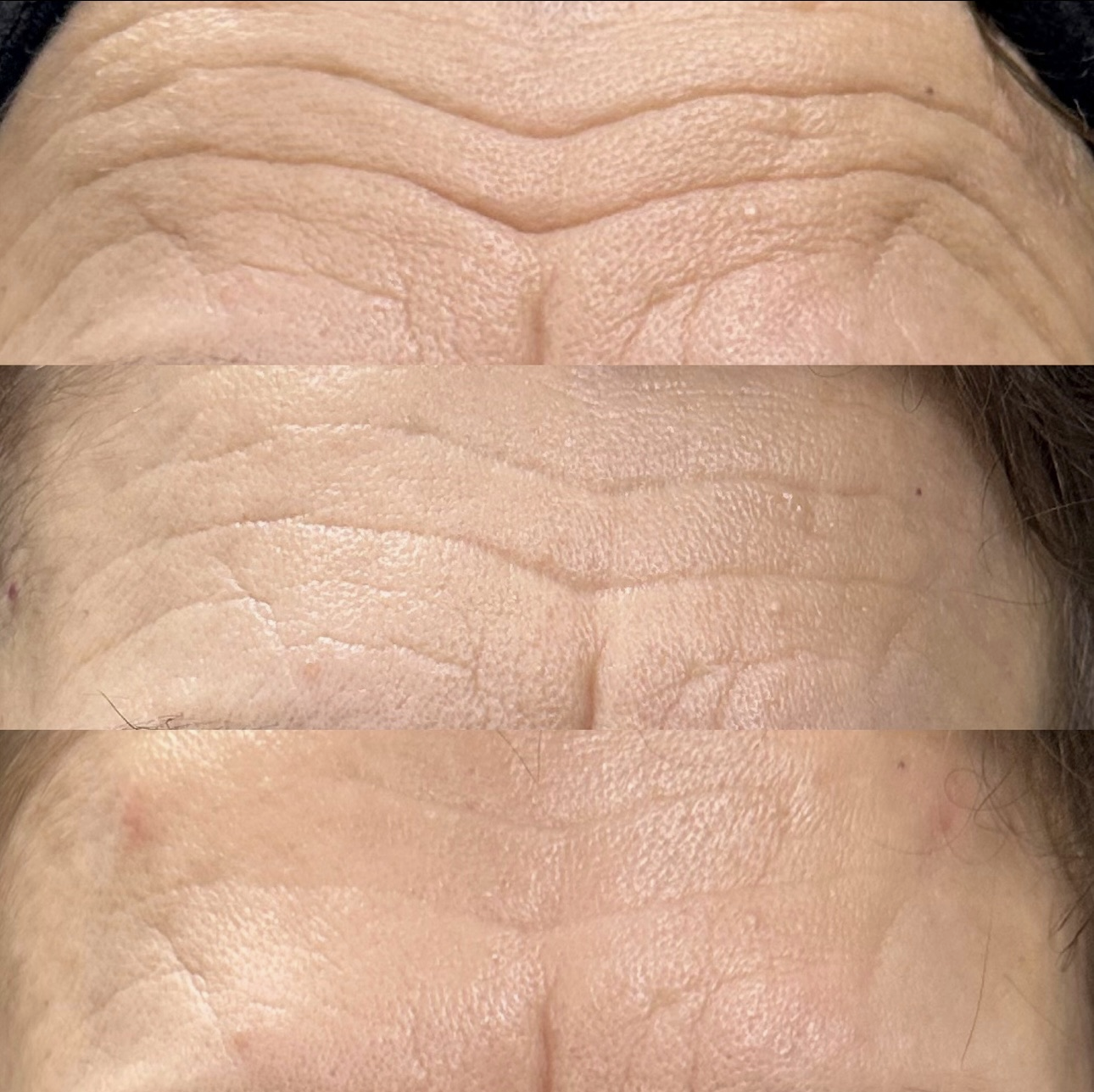 How Long Do Anti-Wrinkle Treatments Last?