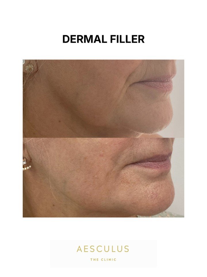 Dermal fillers used in the lower face to support smile lines, peri oral lines and pre jowls. Patients often come to clinic saying they always look sad! While we usually start by targeting anchoring points, in some patients adding filler directly wher