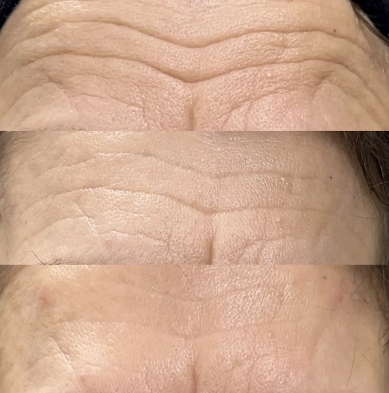 How Long Do Anti-Wrinkle Treatments Last?