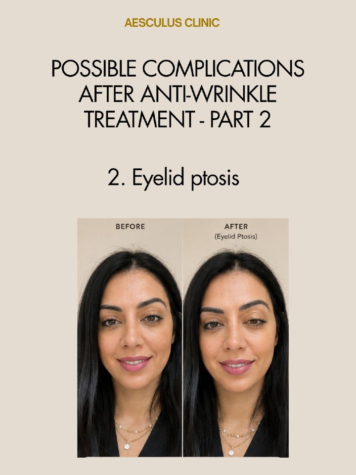 Eyelid pstosis (Droopy eyelid)

Book your consultation online!

Available at New Malden &amp; Knightsbridge 

Aesculus Clinic | Skin Clinic New Malden | Skin Clinic Knightsbridge | Anti-wrinkle treatment New Malden | Anti-wrinkle treatment Knightsbri