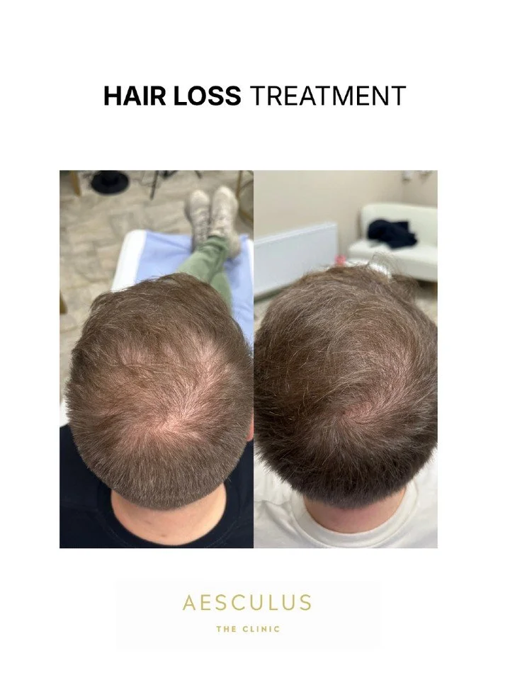 A holistic approach addressing vitamins deficiency, genetic factors, scalp health always gives the best outcome! You cannot treat one aspect of hair loss while ignoring all other contributing factors.

Available at New Malden &amp; Knightsbridge 

Ae