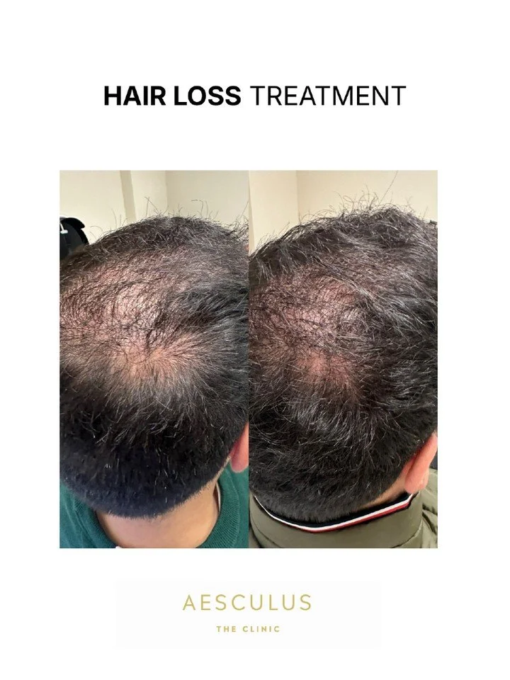 Available at New Malden &amp; Knightsbridge 

Aesculus Clinic | Skin Clinic New Malden | Skin Clinic Knightsbridge | Anti-wrinkle treatment New Malden | Anti-wrinkle treatment Knightsbridge | Lip Filler New Malden | Lip Filler Knightsbridge | Exosome