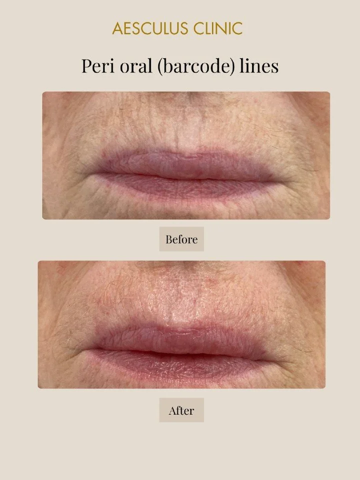 Available at New Malden &amp; Knightsbridge 

Aesculus Clinic | Skin Clinic New Malden | Skin Clinic Knightsbridge | Anti-wrinkle treatment New Malden | Anti-wrinkle treatment Knightsbridge | Lip Filler New Malden | Lip Filler Knightsbridge | Exosome