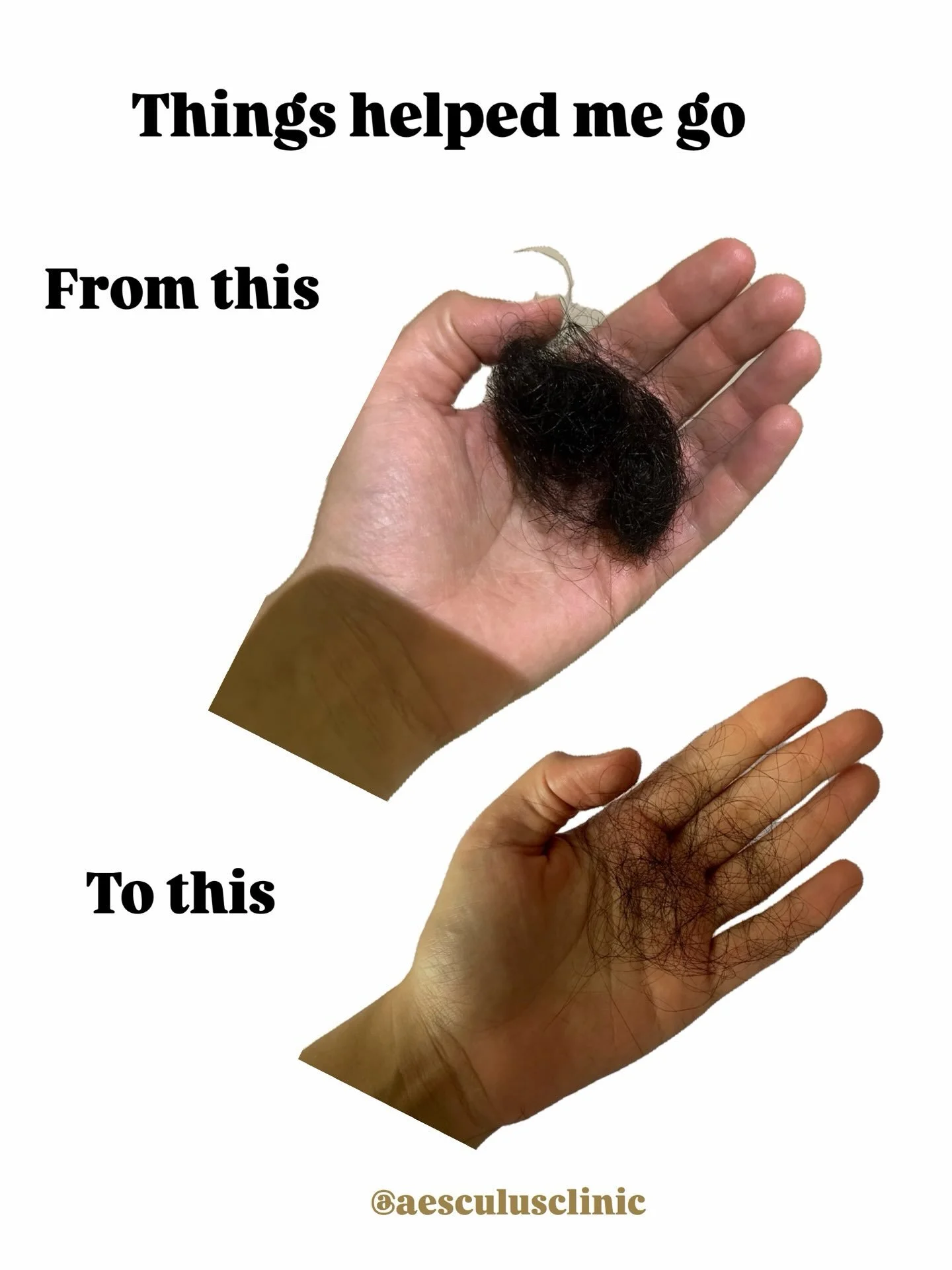 Hair loss is never about one issue. It is mostly caused by multiple issues and we have to address all of them to get meaningful results.

Working on your scalp health while ignoring your vitamin deficiencies will not give you the results you are look