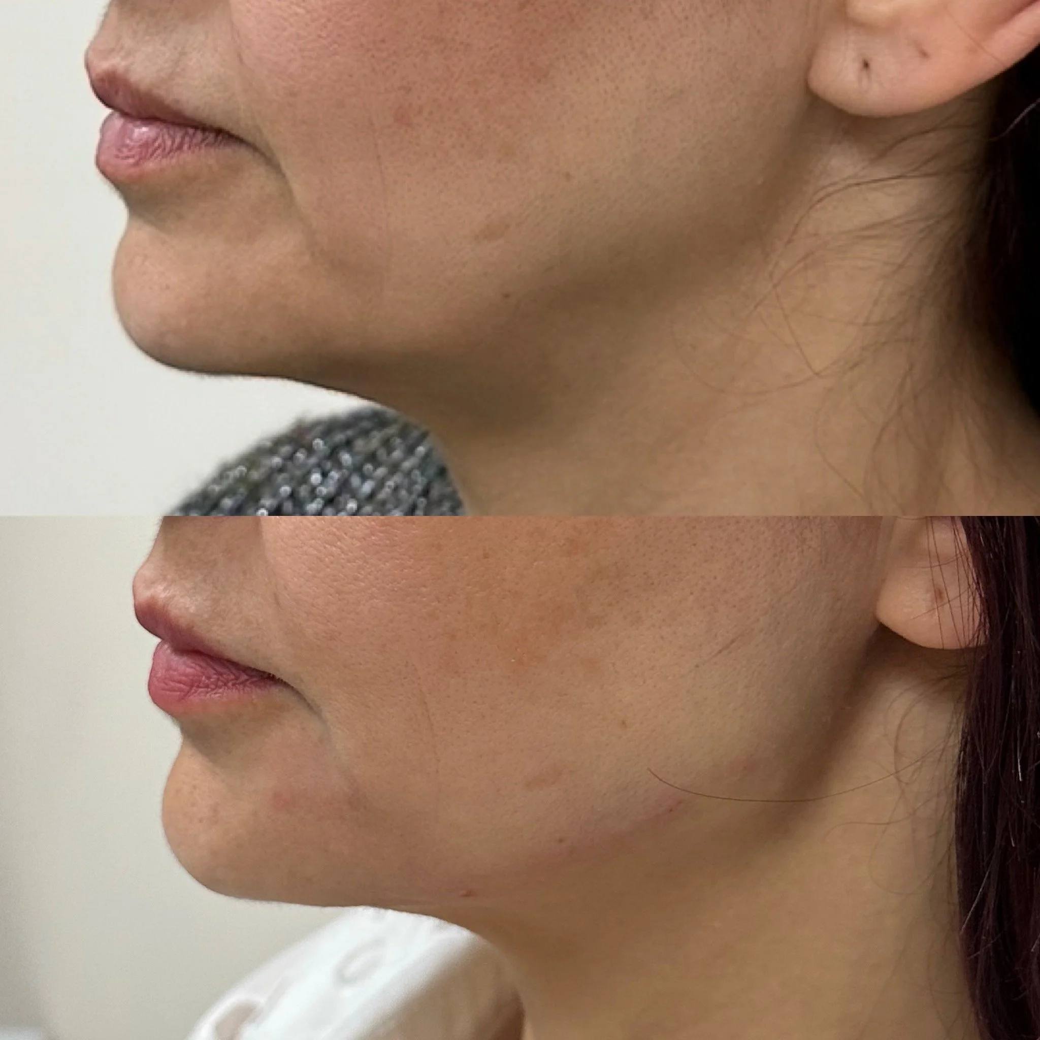 jowls-reduction-before-and-after-dermal-fillers-improving-jawline-contour