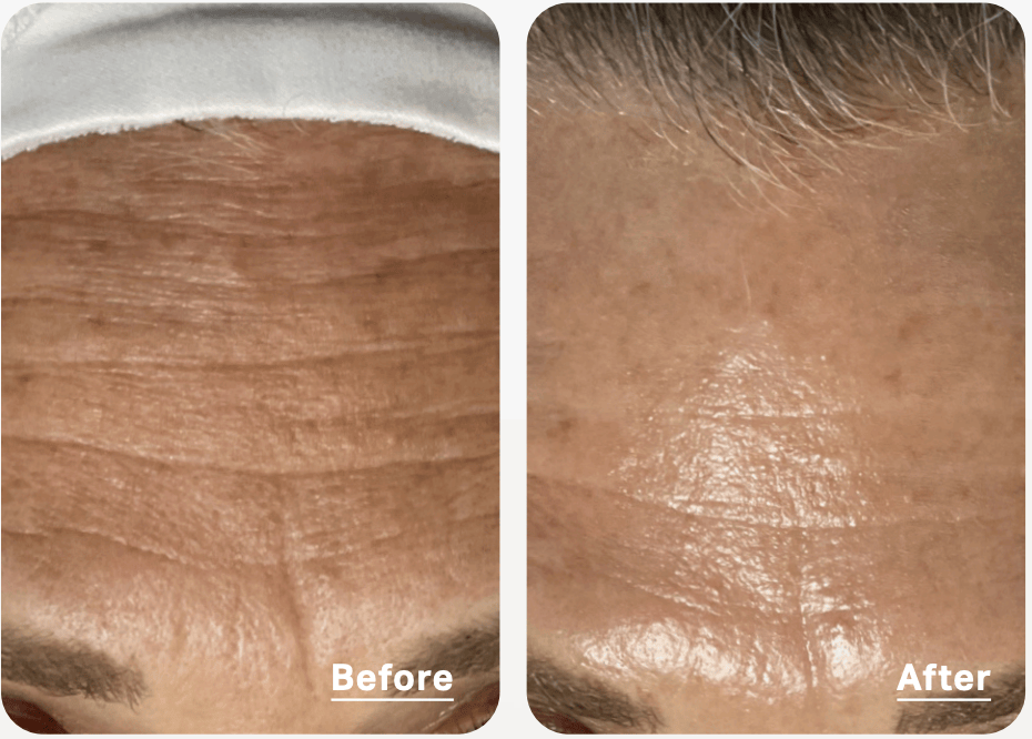 hydrafacial improves wrinkles on forehead