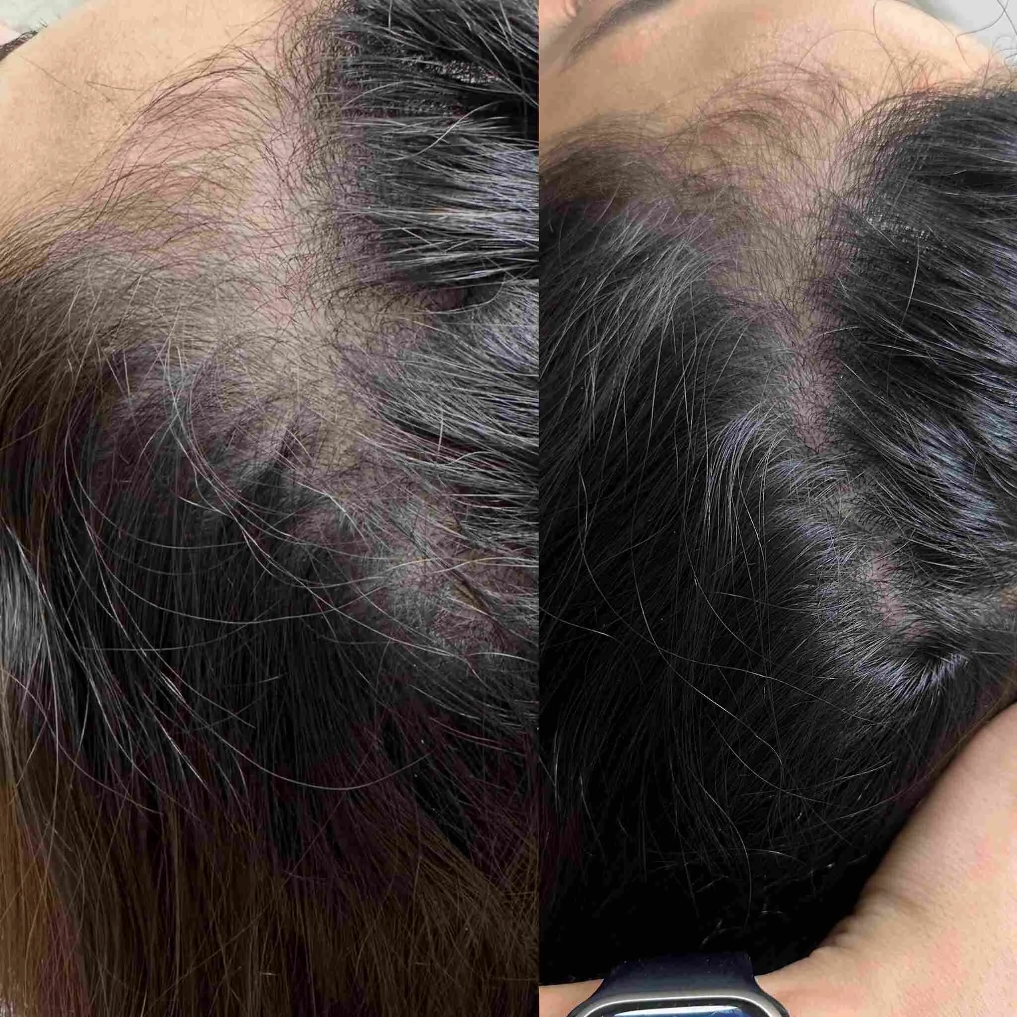 hair loss with exosomes