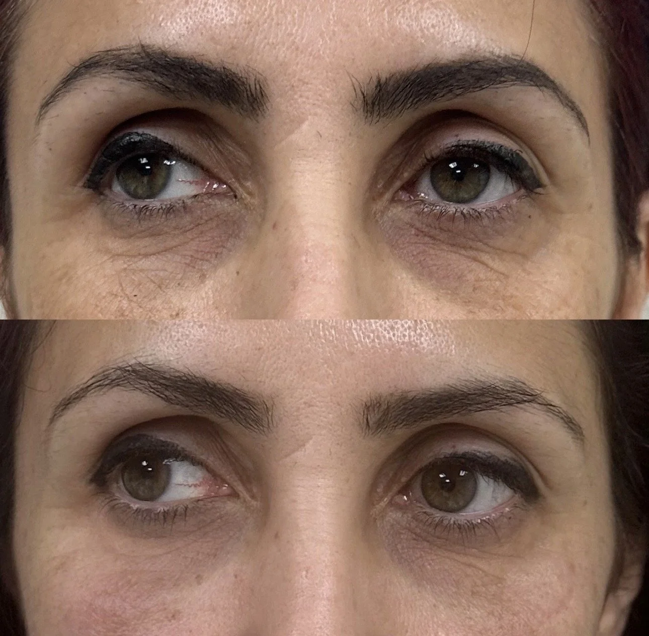 Tear trough filler in New Malden