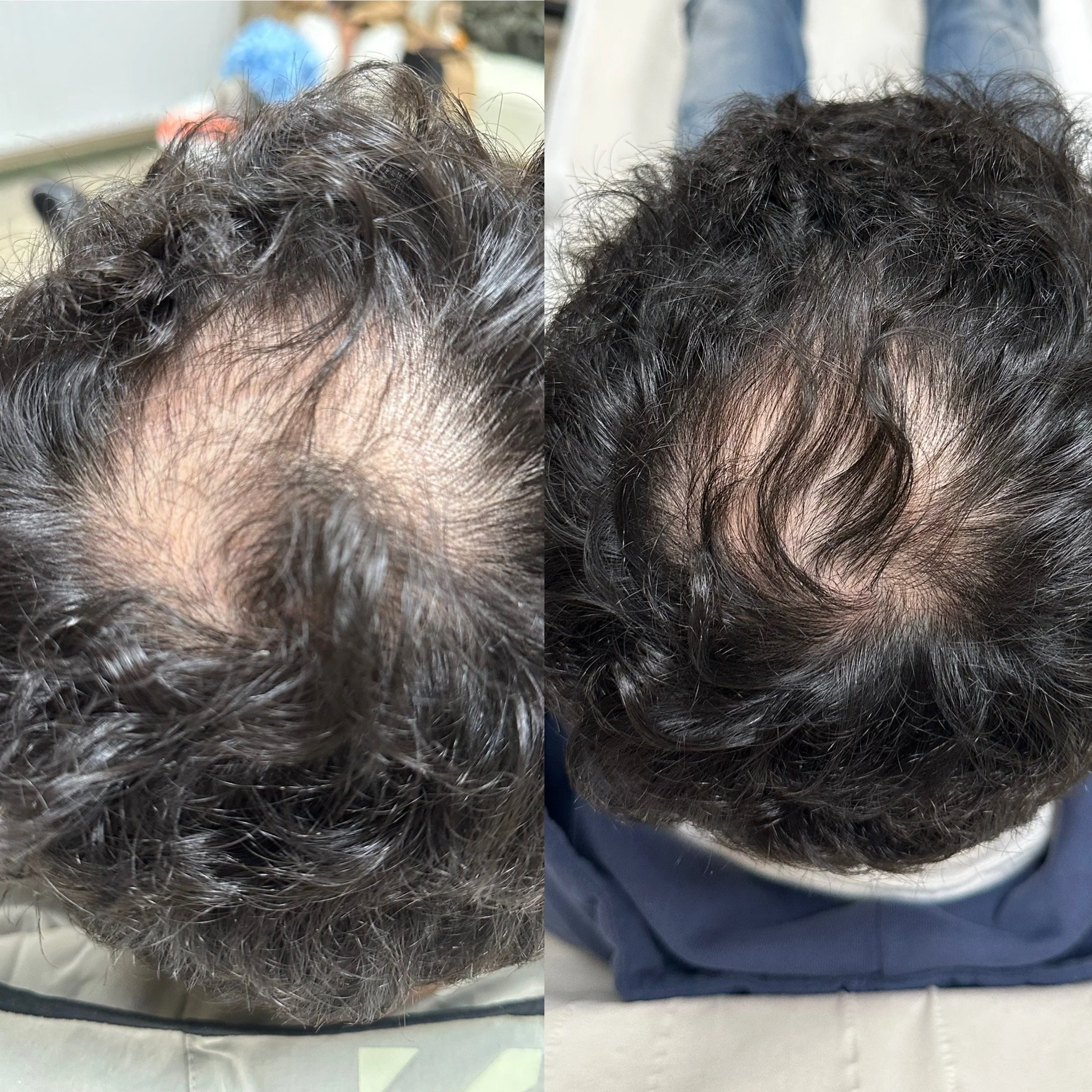 Hair loss Aesculus Clinic.JPG