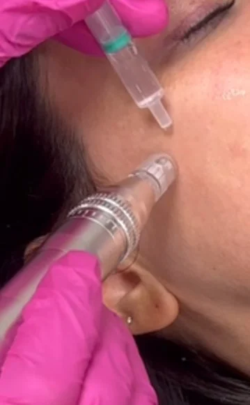 exosomes-with-microneedling-treatment-applied-to-scalp-for-skin-and-hair-rejuvenation-aesculus-clinic