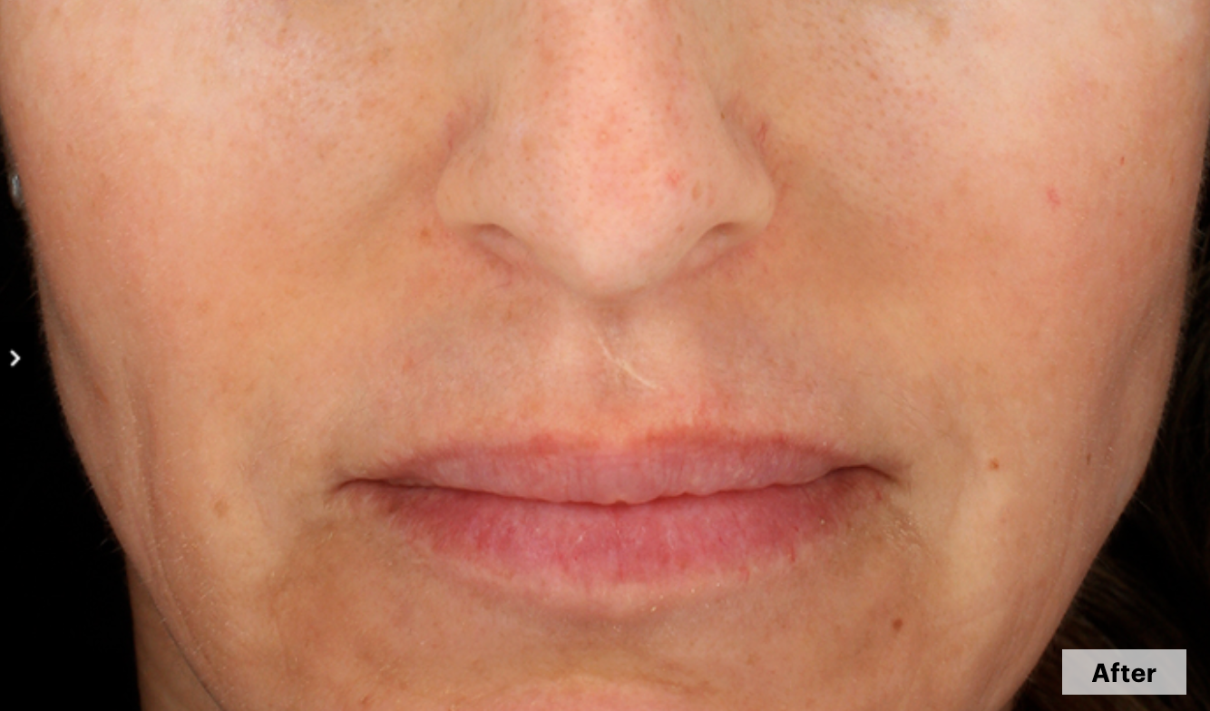 After-cosmelan-treatment-aesculus-clinic