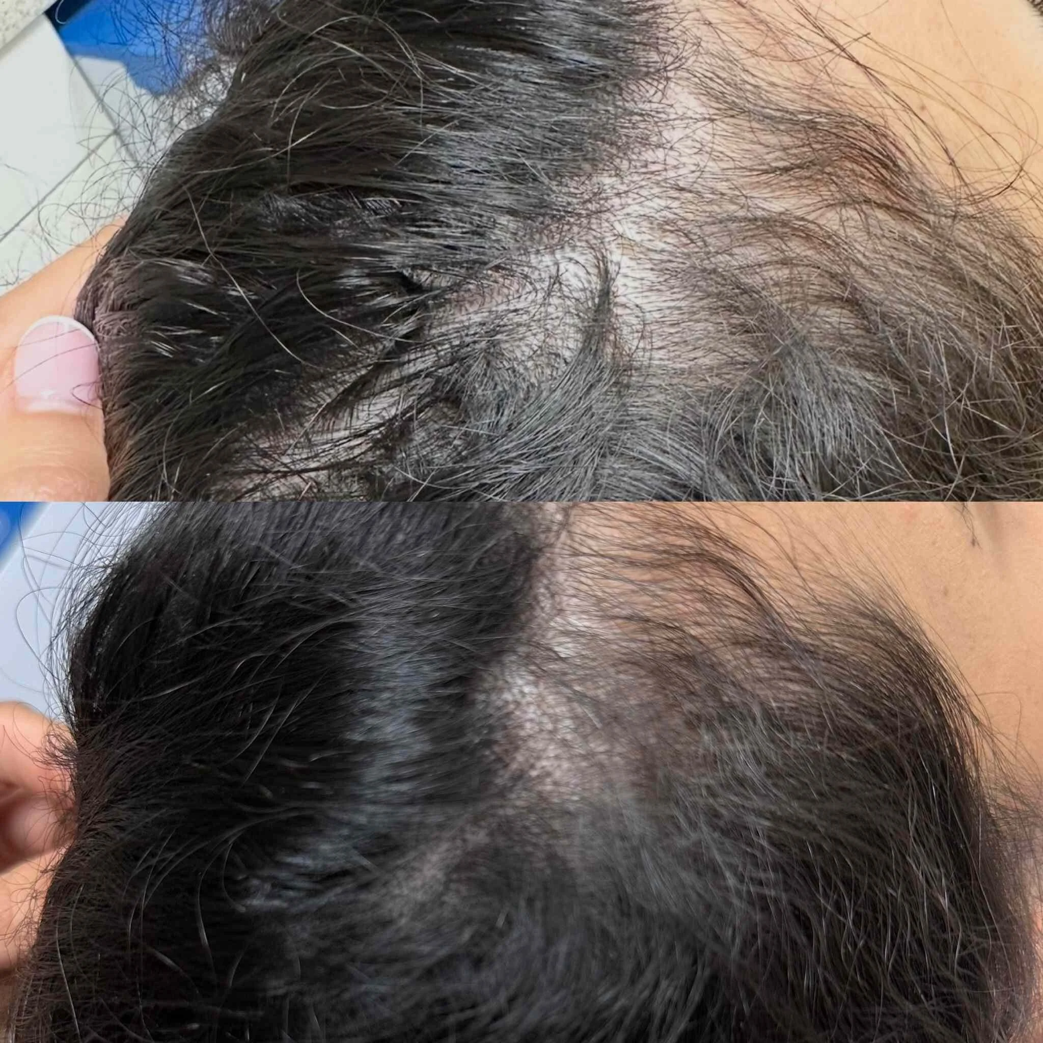 exosomes for hair loss